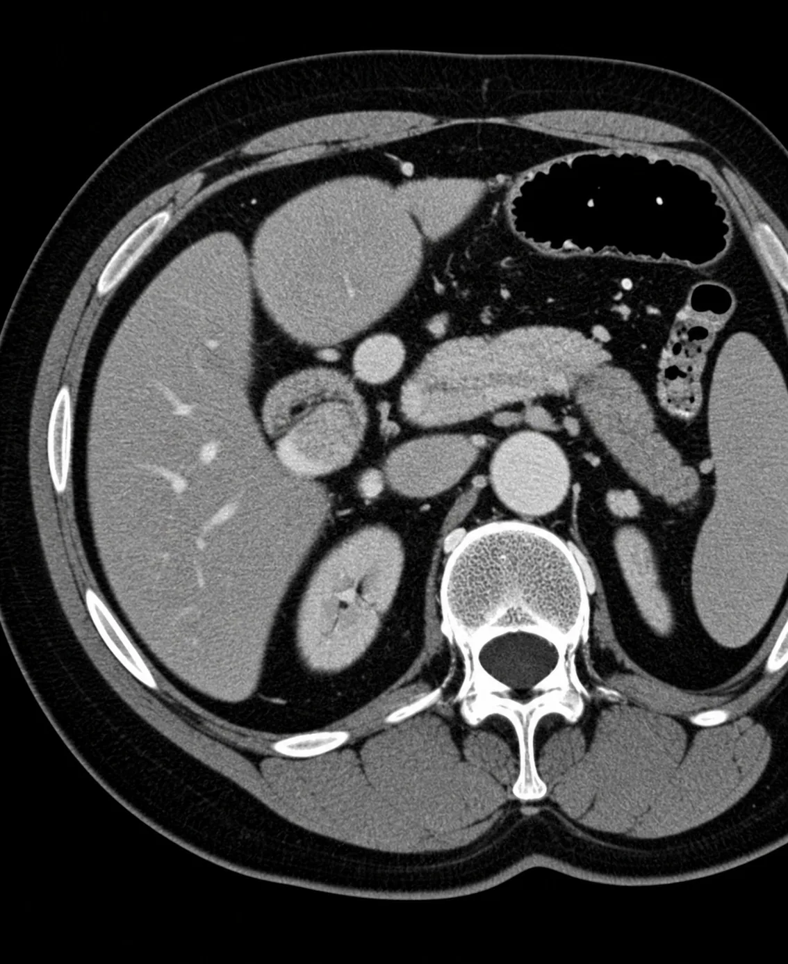 Abdominal CT scan image